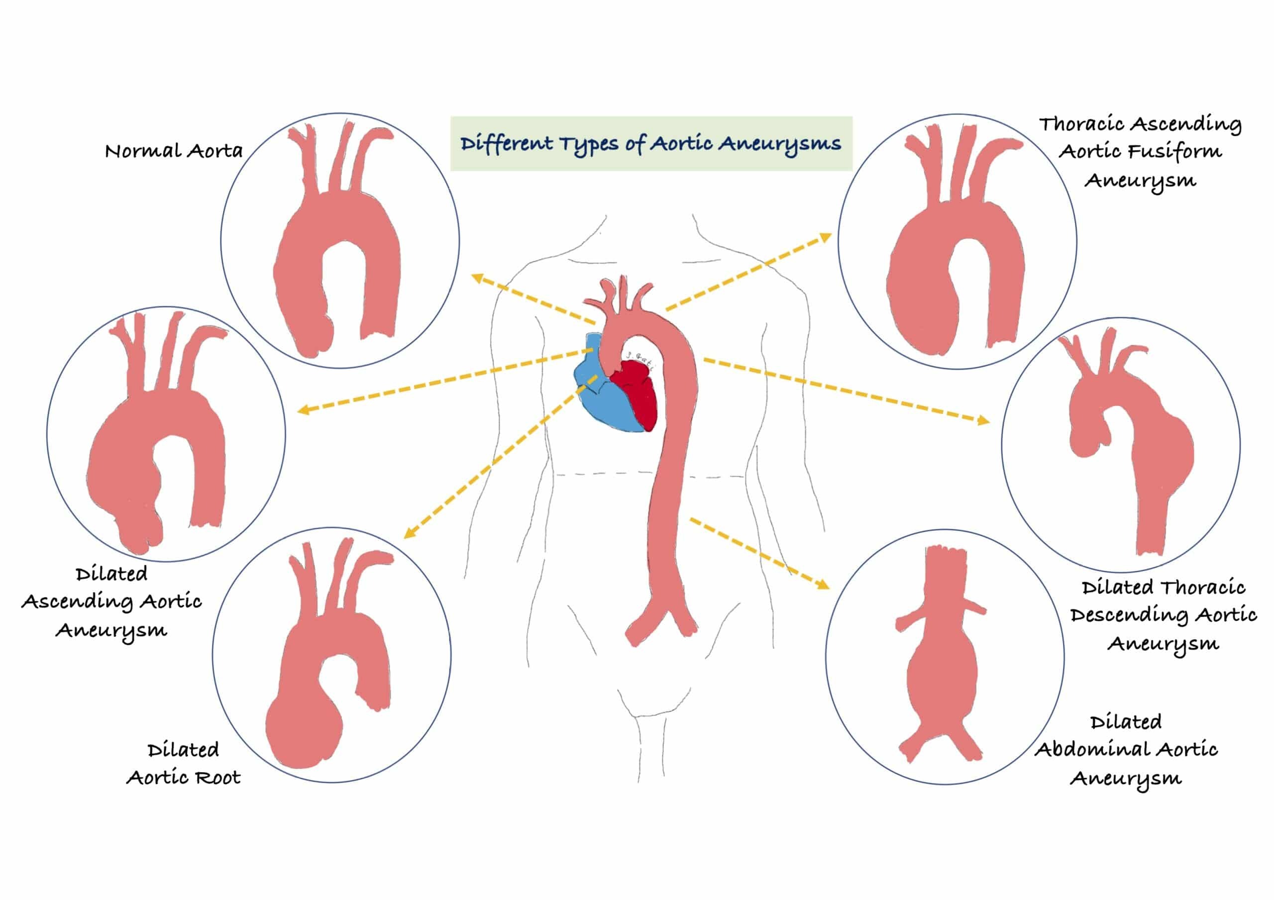 September is Aortic Disease Awareness Month!